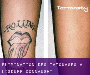 Élimination des tatouages à Lisduff (Connaught)