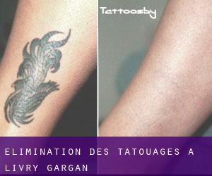 Élimination des tatouages à Livry-Gargan