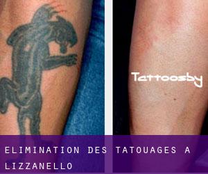 Élimination des tatouages à Lizzanello