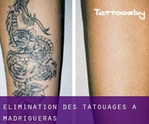 Élimination des tatouages à Madrigueras