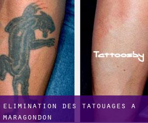 Élimination des tatouages à Maragondon