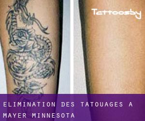 Élimination des tatouages à Mayer (Minnesota)