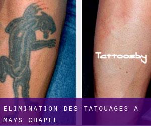 Élimination des tatouages à Mays Chapel