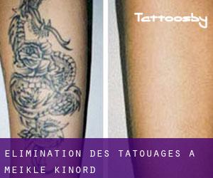 Élimination des tatouages à Meikle Kinord