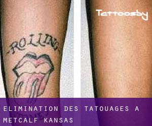 Élimination des tatouages à Metcalf (Kansas)