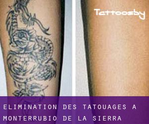 Élimination des tatouages à Monterrubio de la Sierra