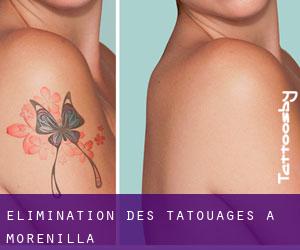 Élimination des tatouages à Morenilla