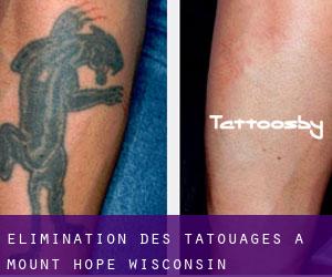 Élimination des tatouages à Mount Hope (Wisconsin)