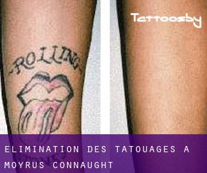 Élimination des tatouages à Moyrus (Connaught)