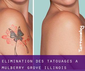 Élimination des tatouages à Mulberry Grove (Illinois)