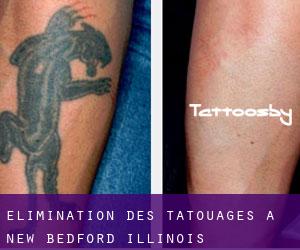Élimination des tatouages à New Bedford (Illinois)