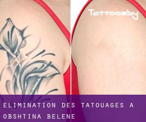 Élimination des tatouages à Obshtina Belene