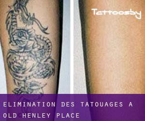 Élimination des tatouages à Old Henley Place