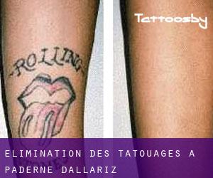 Élimination des tatouages à Paderne d'Allariz