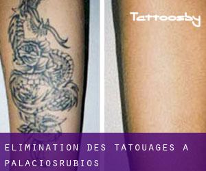 Élimination des tatouages à Palaciosrubios