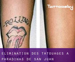 Élimination des tatouages à Paradinas de San Juan