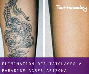 Élimination des tatouages à Paradise Acres (Arizona)