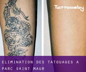Élimination des tatouages à Parc Saint-Maur