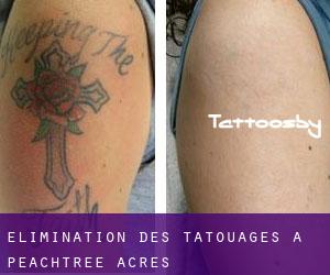 Élimination des tatouages à Peachtree Acres