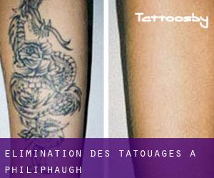 Élimination des tatouages à Philiphaugh