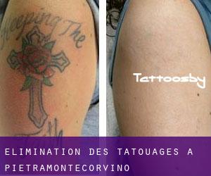 Élimination des tatouages à Pietramontecorvino