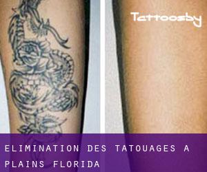 Élimination des tatouages à Plains (Florida)