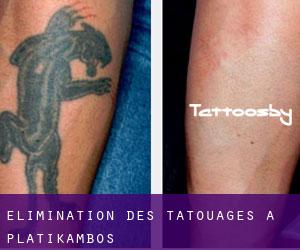 Élimination des tatouages à Platíkambos