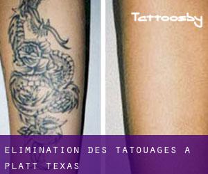 Élimination des tatouages à Platt (Texas)