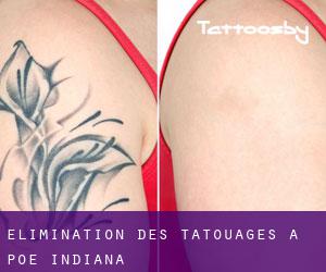 Élimination des tatouages à Poe (Indiana)
