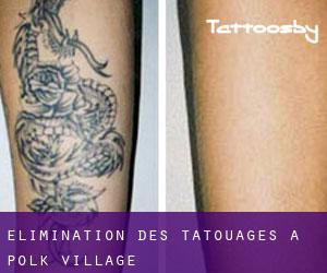 Élimination des tatouages à Polk Village