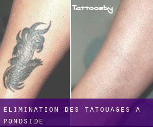 Élimination des tatouages à Pondside