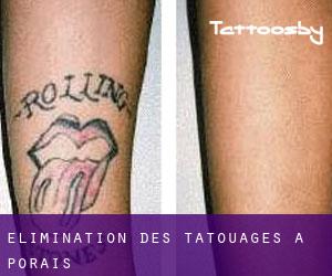 Élimination des tatouages à Porais