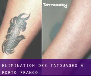 Élimination des tatouages à Porto Franco