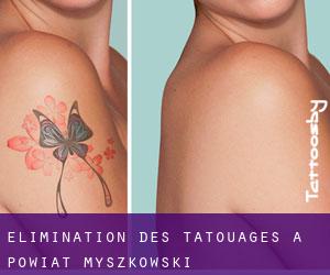 Élimination des tatouages à Powiat myszkowski