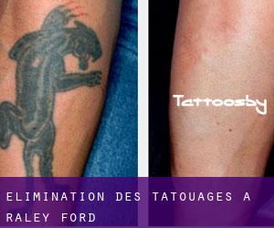 Élimination des tatouages à Raley Ford