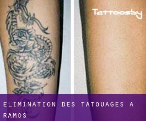 Élimination des tatouages à Ramos
