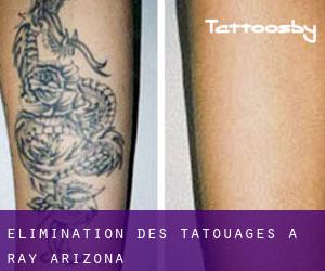 Élimination des tatouages à Ray (Arizona)