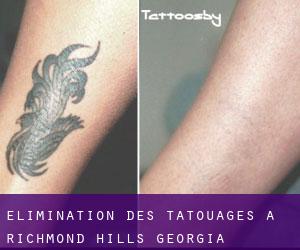 Élimination des tatouages à Richmond Hills (Georgia)