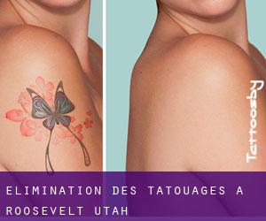Élimination des tatouages à Roosevelt (Utah)
