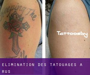 Élimination des tatouages à Rus