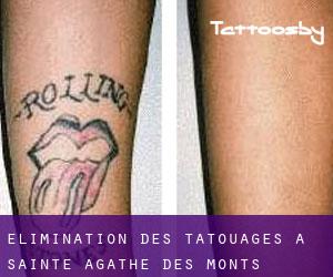 Élimination des tatouages à Sainte-Agathe-des-Monts