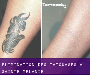 Élimination des tatouages à Sainte-Mélanie