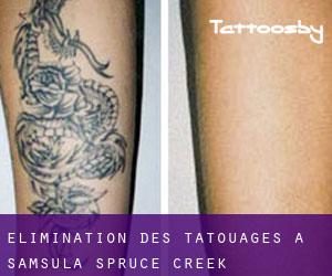 Élimination des tatouages à Samsula-Spruce Creek