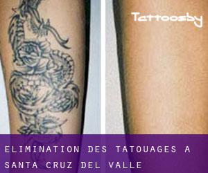 Élimination des tatouages à Santa Cruz del Valle