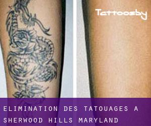 Élimination des tatouages à Sherwood Hills (Maryland)