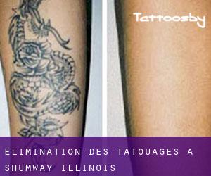 Élimination des tatouages à Shumway (Illinois)