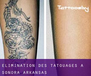 Élimination des tatouages à Sonora (Arkansas)