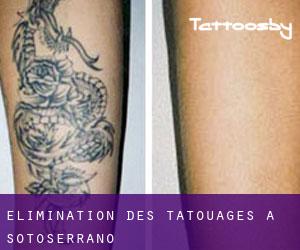 Élimination des tatouages à Sotoserrano