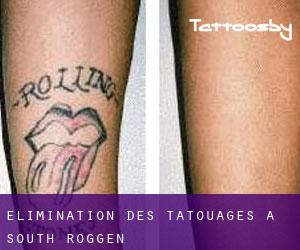 Élimination des tatouages à South Roggen