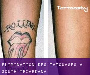 Élimination des tatouages à South Texarkana